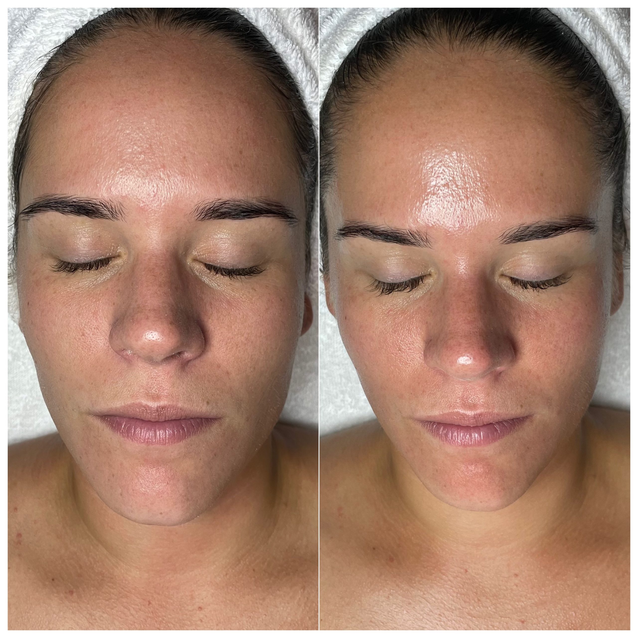 dermaplaning before and after Philadelphia