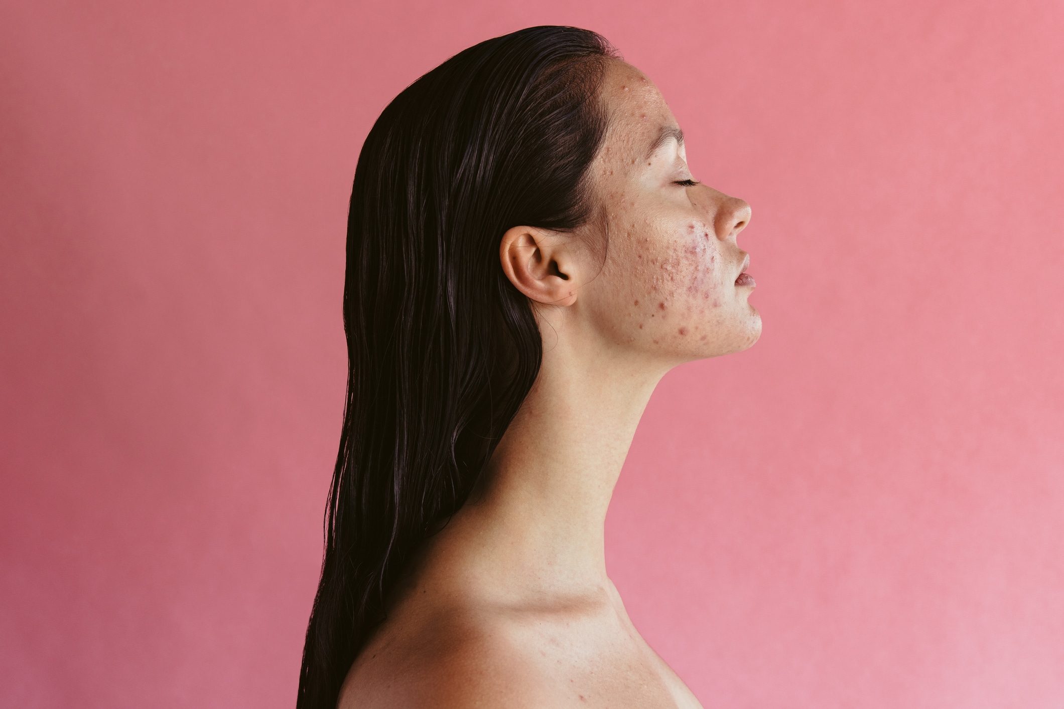 Do you want o face the reality of the causes of acne? Let's us help you at Viviane Aires Skin Wellness Philadelphia.