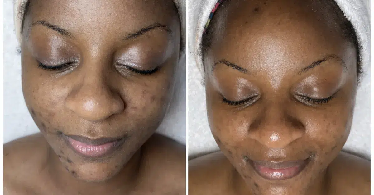 Hyperpigmentation treatment program Philadelphia
