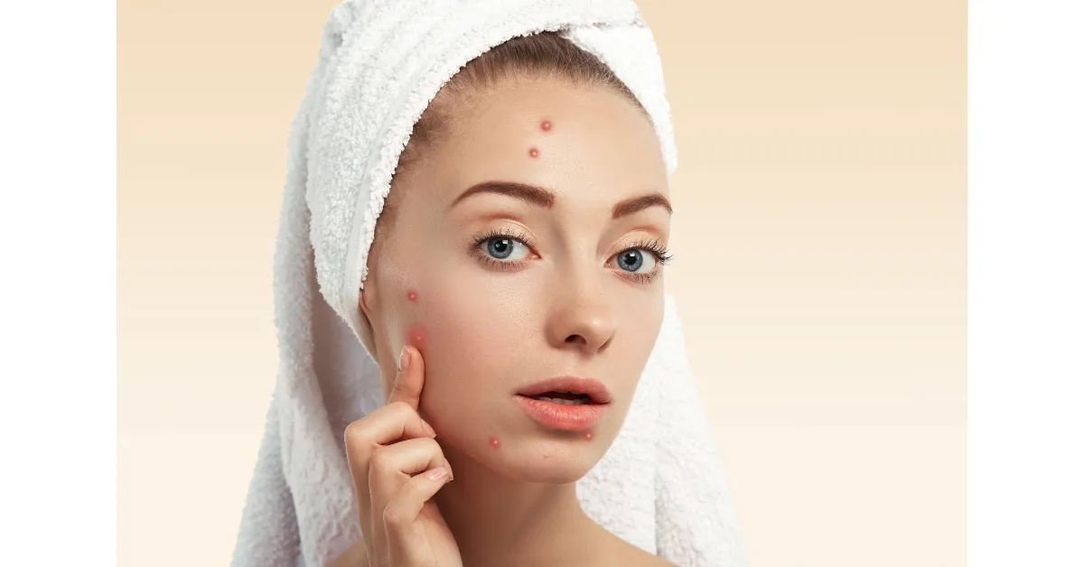 professional acne facial treatment philadelphia clinic