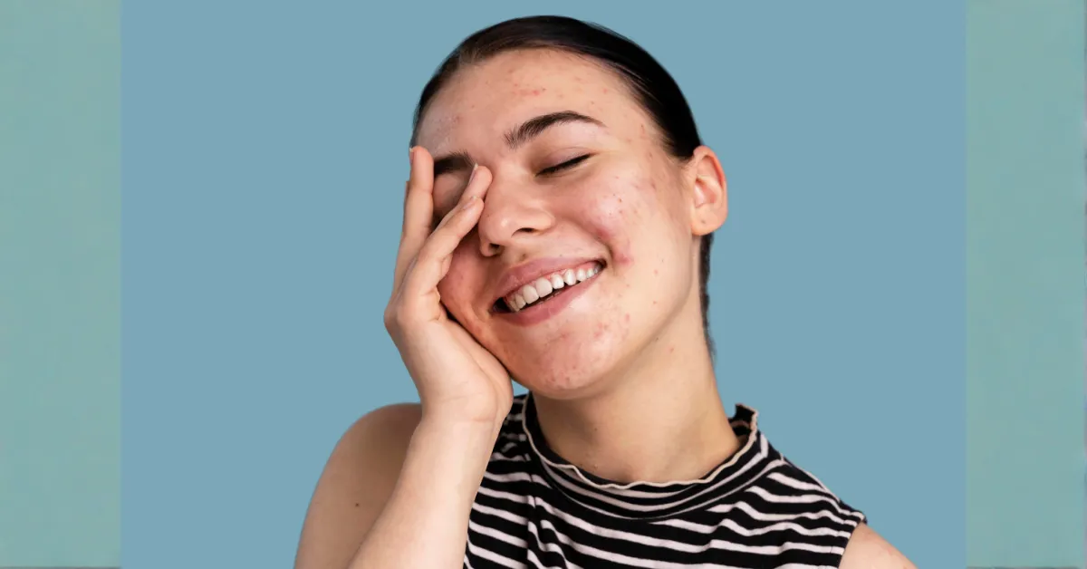 clogged pores and acne causes skincare diagram