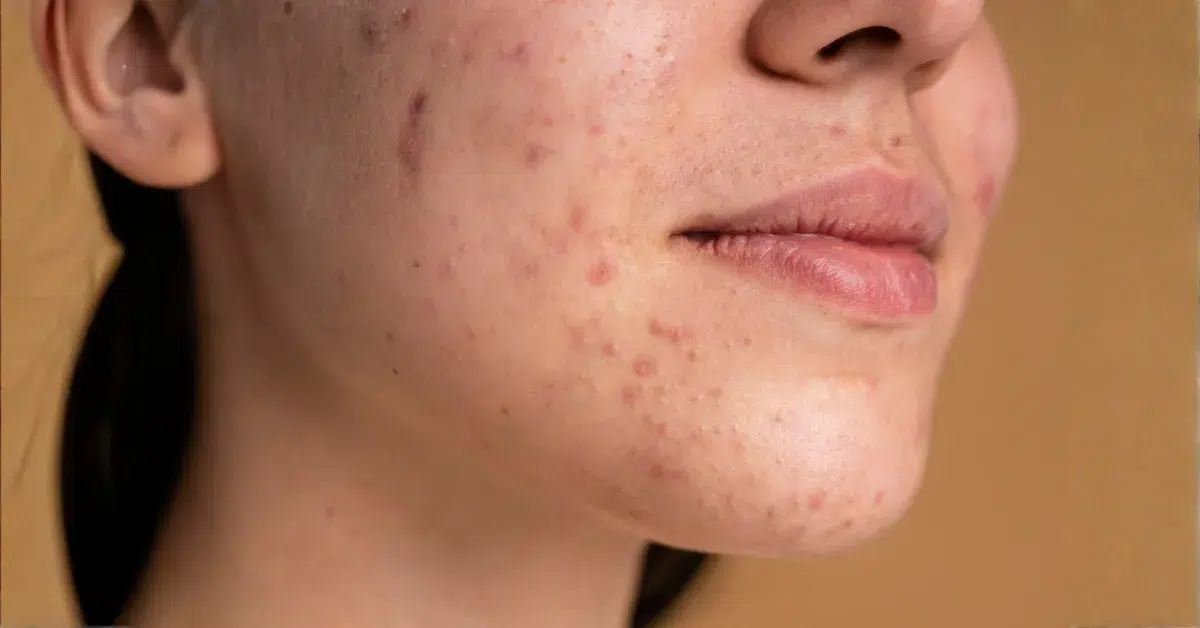 licensed esthetician performing acne facial philadelphia