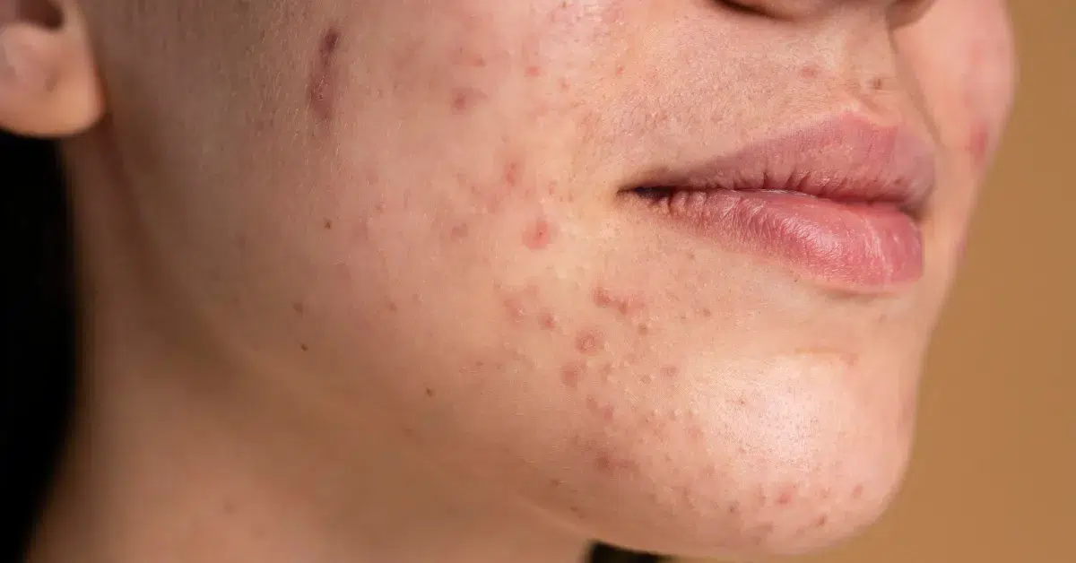 Licensed esthetician performing a hormonal acne facial in Philadelphia