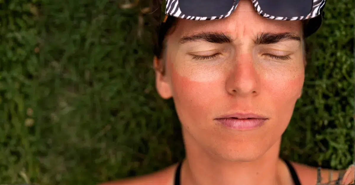 Woman with dull dehydrated skin in summer skincare routine
