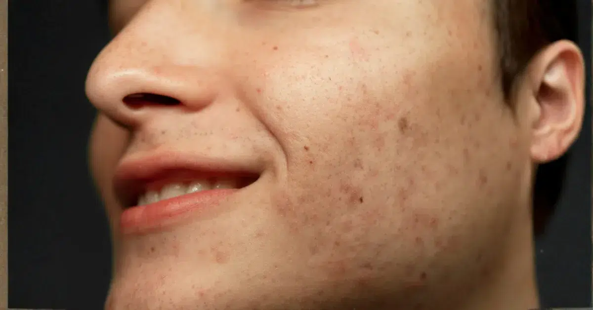 Professional facial care for summer hyperpigmentation and uneven skin tone