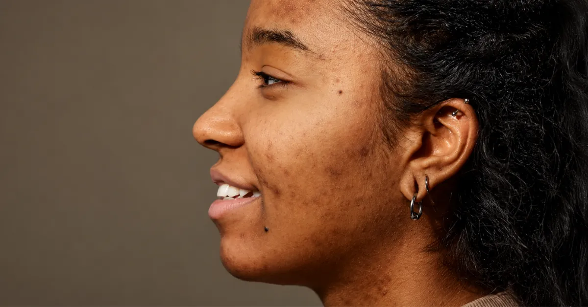 Recurring adult acne breakouts on acne-prone skin