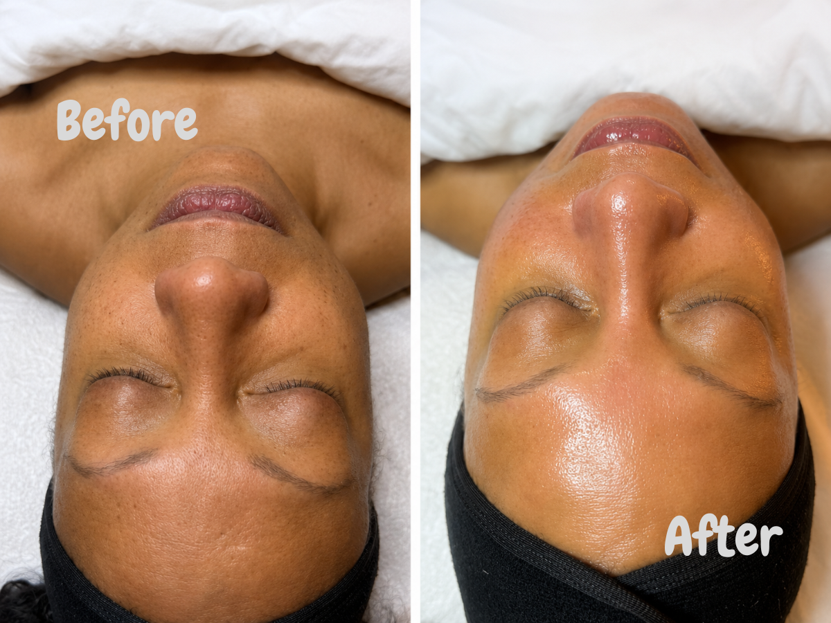 Best Chemical Peels Facial in Philadelphia Viviane Aires