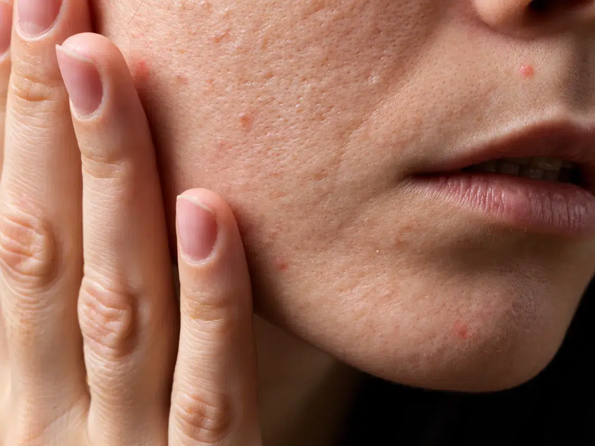 Damaged skin barrier with dryness, sensitivity, and rough texture
