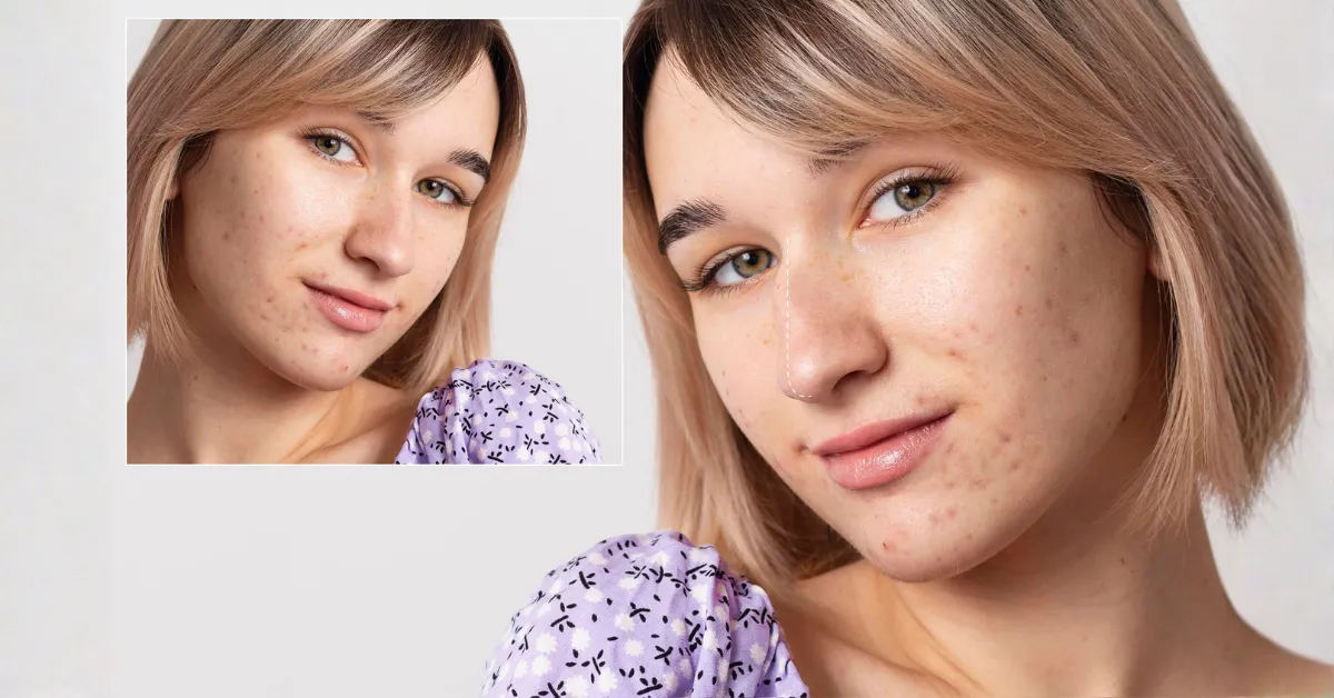 Dark marks after acne on melanin-rich skin