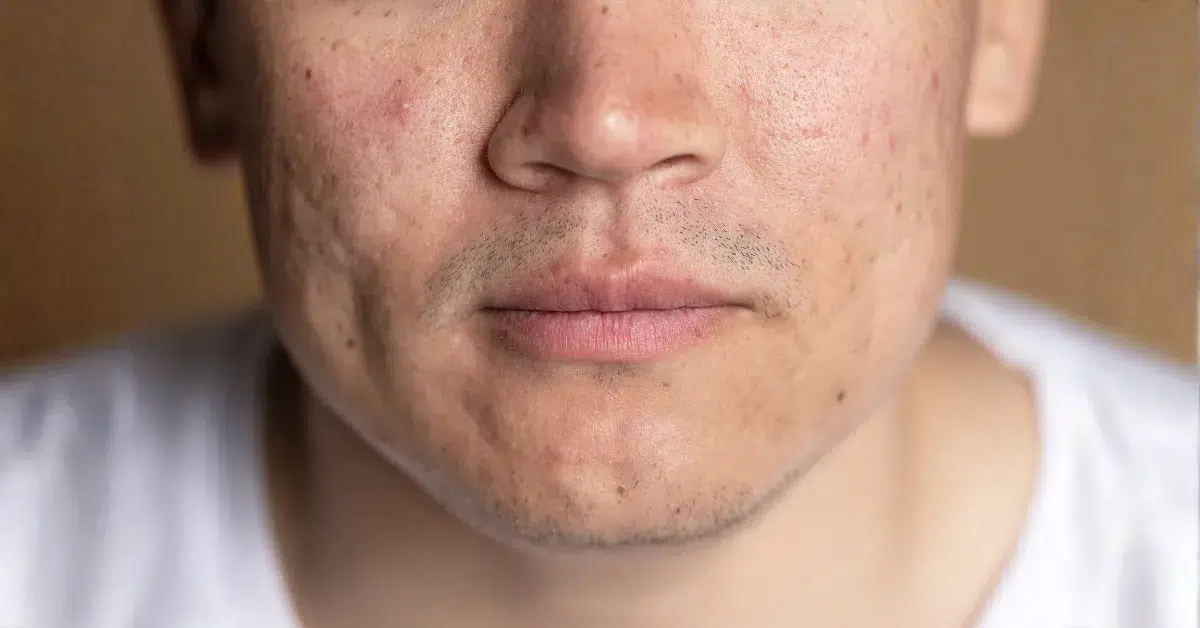 Flat post-acne dark marks left after breakouts